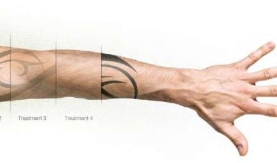 Tattoo removal with laser