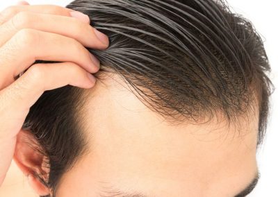 PRP plasma therapy for the prevention of hair loss